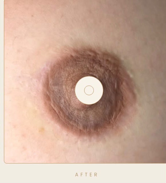 3D areola restoration — after