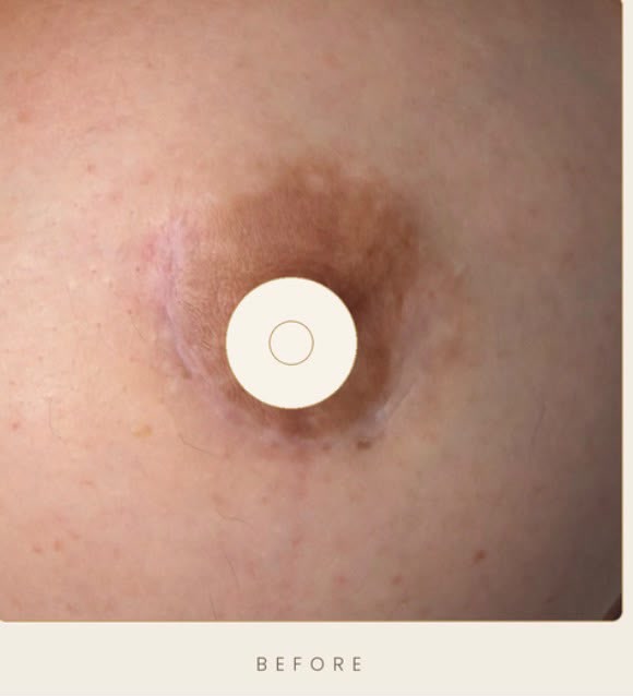 3D areola restoration — before