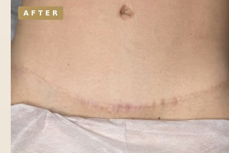 Abdominal scar camouflage — after