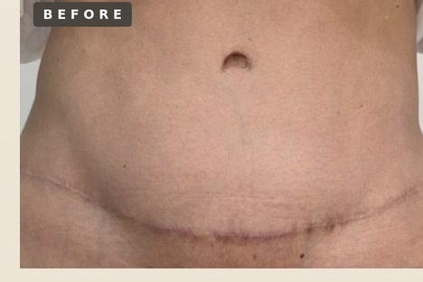 Abdominal scar camouflage — before