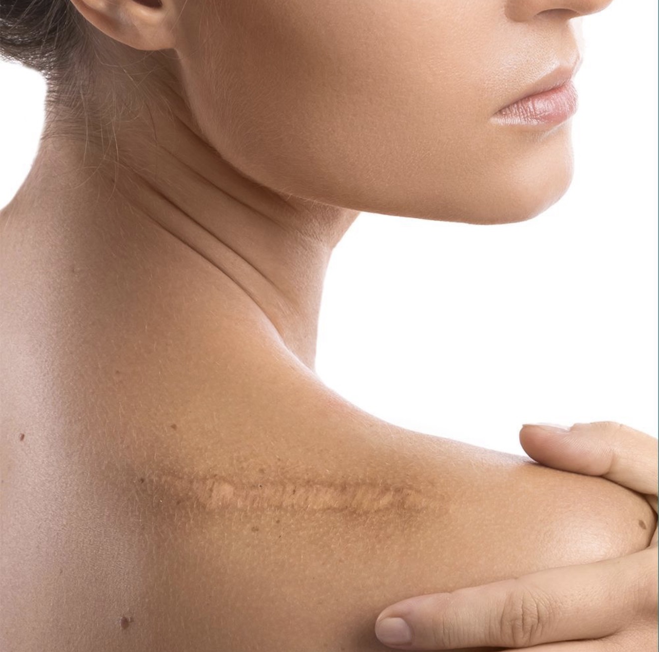 Scar Camouflage treatment