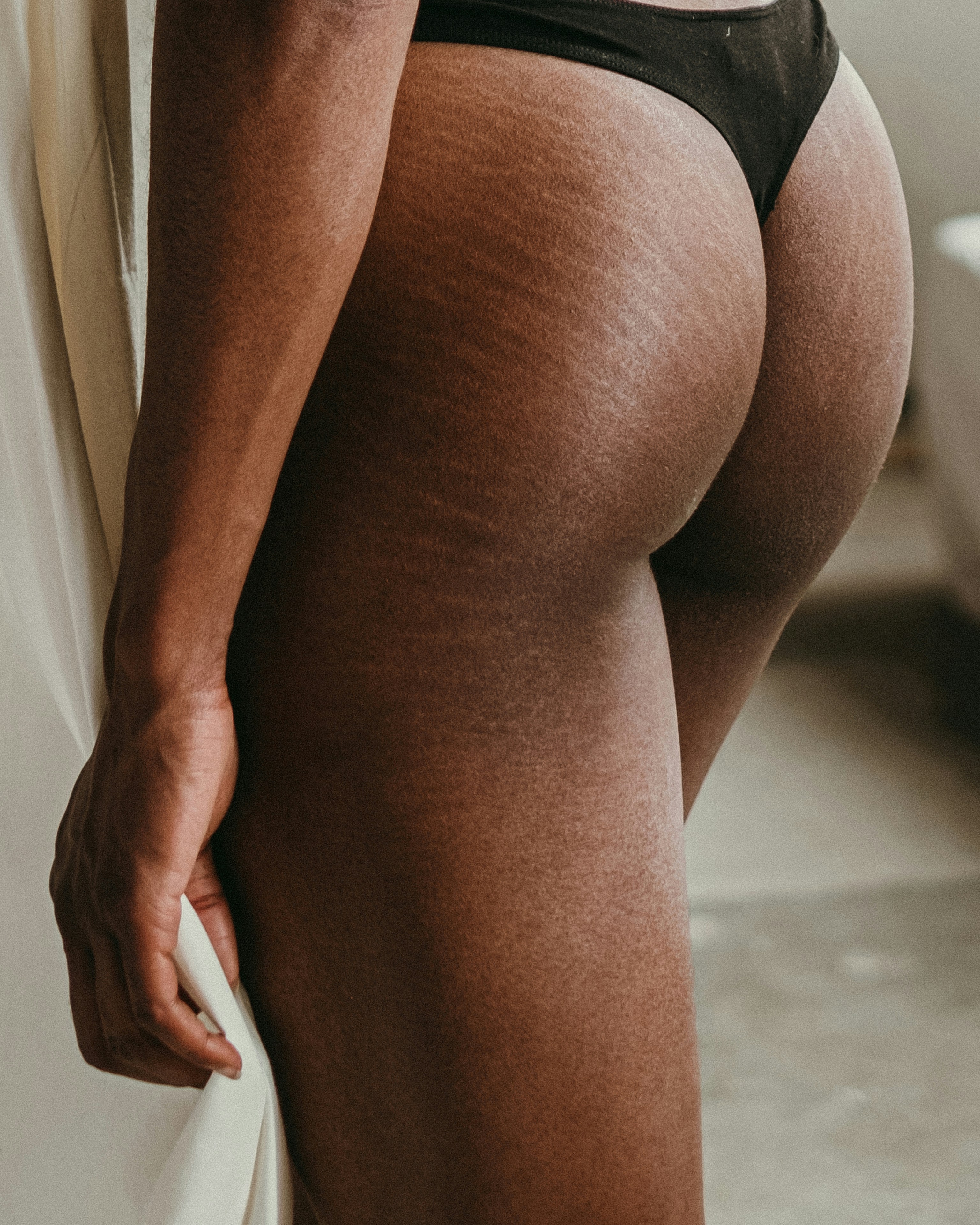 Stretch Mark Camouflage treatment